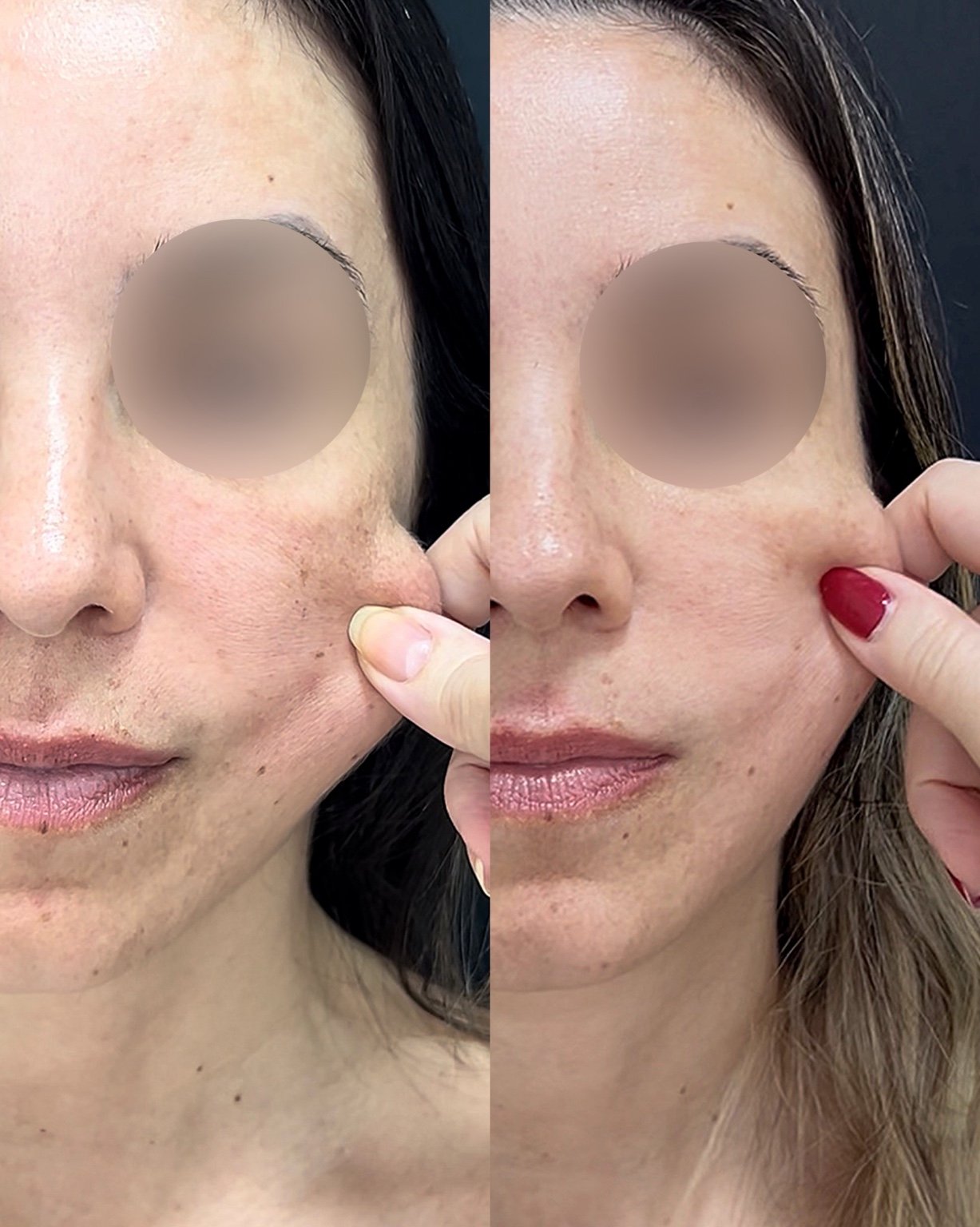 Antes e depois de bioestimulador de colágeno