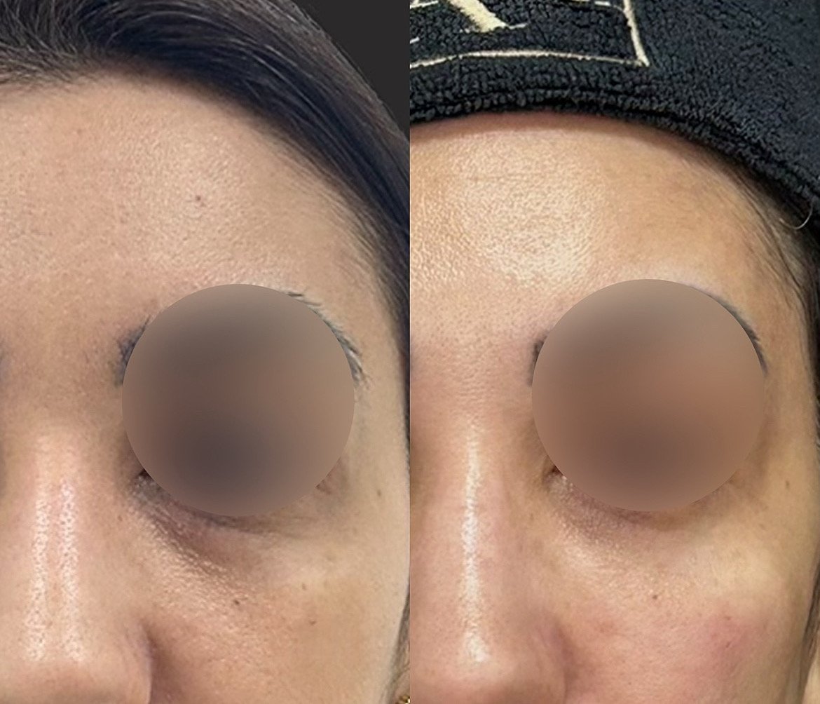 Antes e depois de tratamento de olheiras