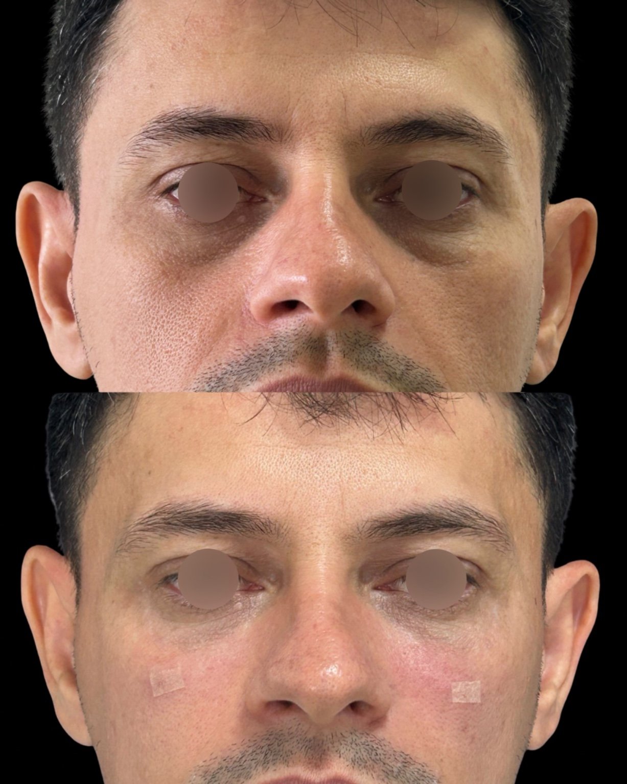 Antes e depois de tratamento de olheiras em paciente masculino
